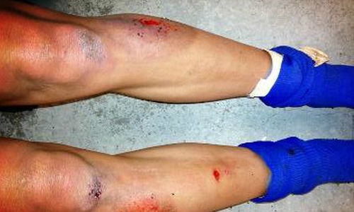 a norte-americana Sydney Leroux e a australiana Samantha Kerr publicaram fotos de arranhões e queimaduras causados pela grama sintética